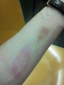 Bow String Injury: How to Prevent and Treat It. | infoarchery.com